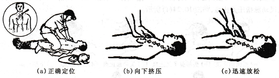胸外心臟按壓法