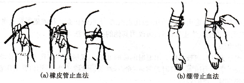 止血帶止血法