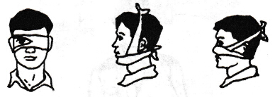 四頭帶包扎創(chuàng)傷法